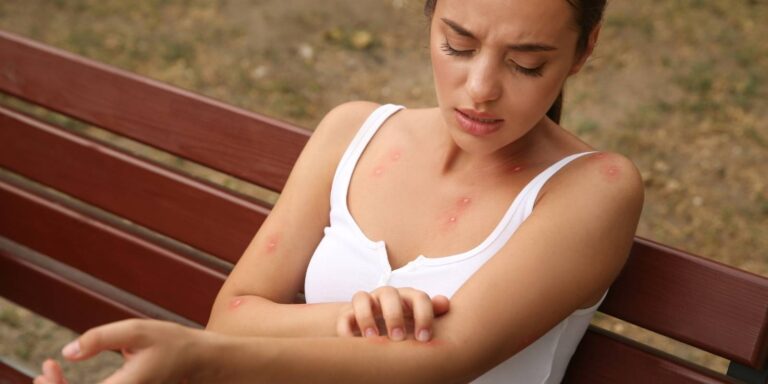 Cómo Quitar Picor Picadura Mosquito