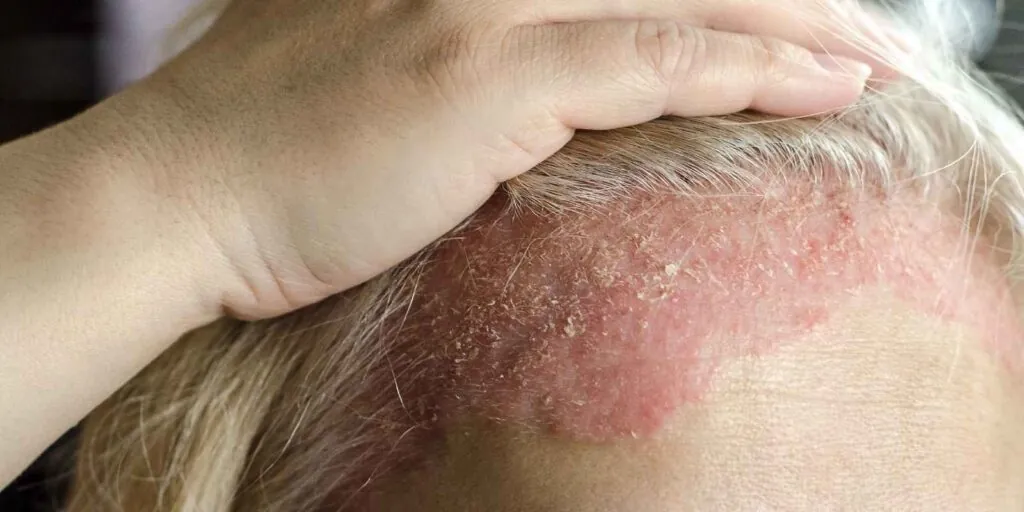 Dermatitis seborreica