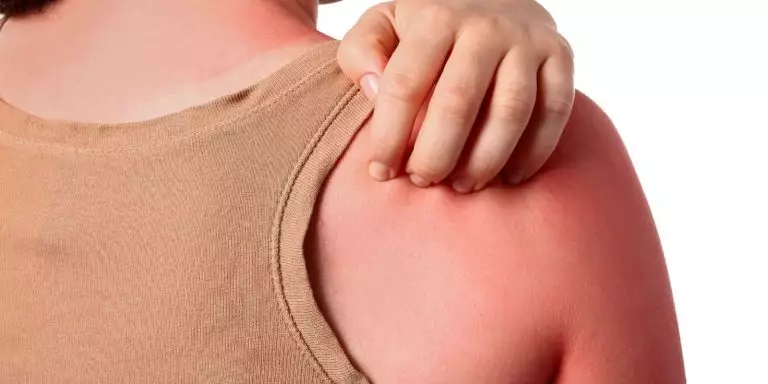 Quemadura Solar