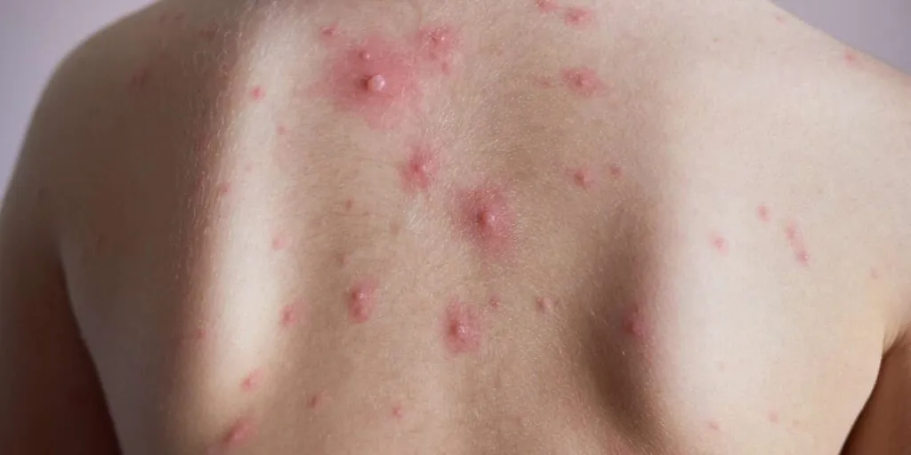 granos en la espalda