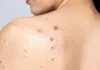 porque me salen granos en la espalda