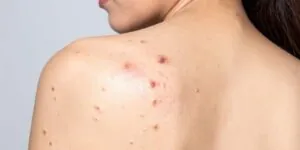 porque me salen granos en la espalda