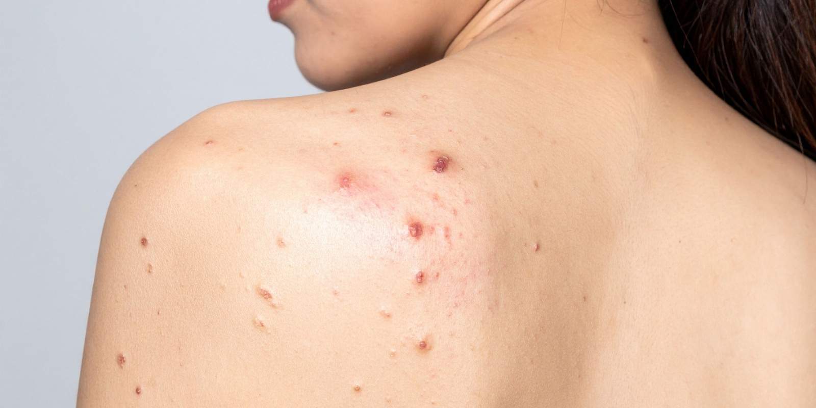 porque me salen granos en la espalda